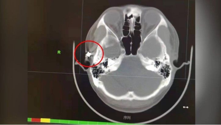 MRI peluru di kepala (Weibo)